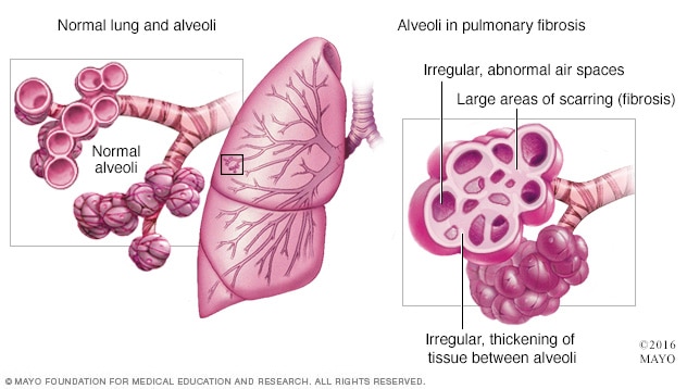 What Is the Prognosis for Pulmonary Fibrosis? - Responsum Health