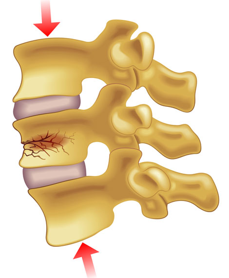 Compression Fracture Lumbar