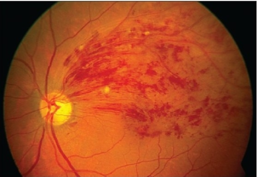 Retinal Vein and Artery Occlusions – Retina Group of New England image.