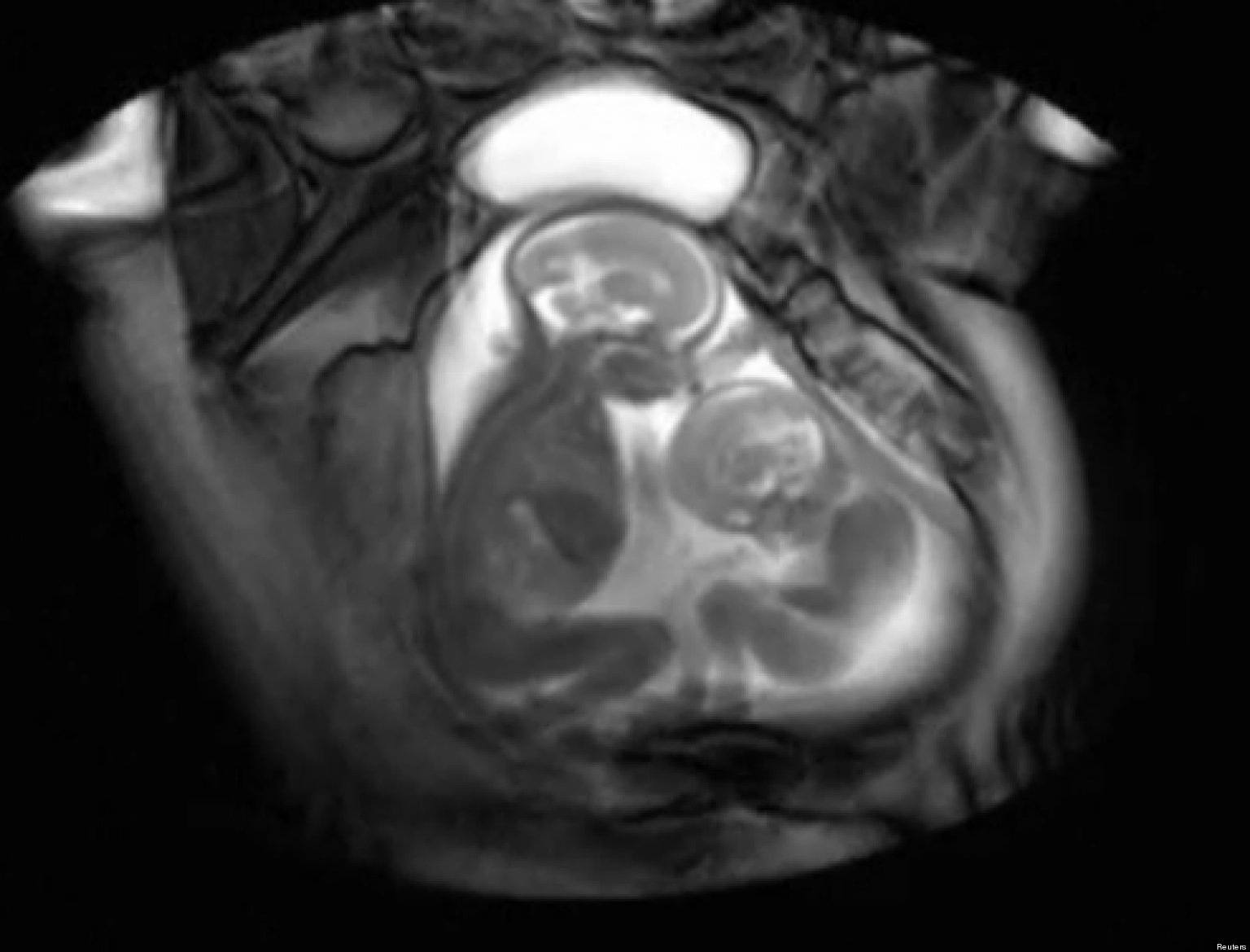 Twins Fighting In Womb Video: New MRI Technique Reveals Early Double ...