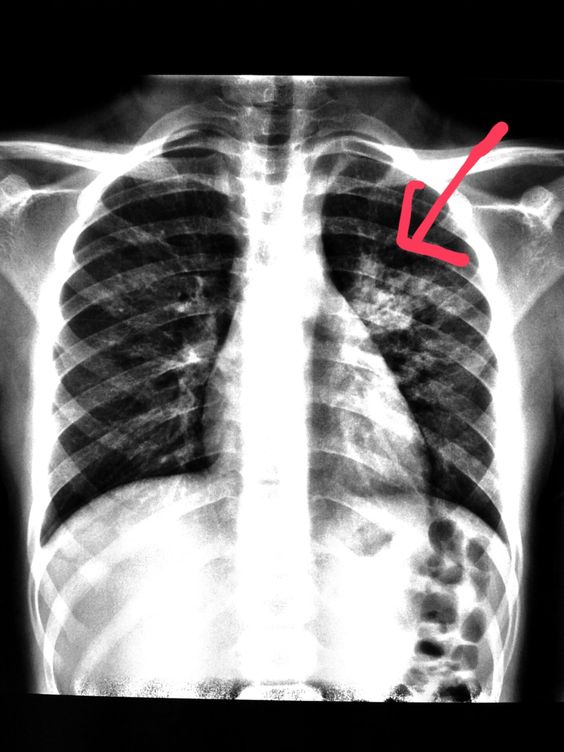 #Chest #xray of a #child with a #cough shows #pneumonia. #radiologist # ...