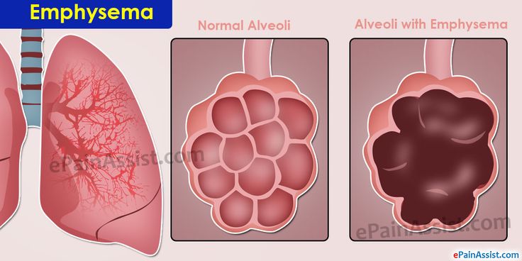 102 best images about Chest on Pinterest | Heart disease, Chronic ...