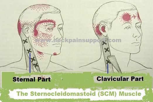 The SCM Muscle in the Neck, | Massage | Pinterest | Spinal stenosis ...