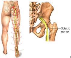 Over 1000 idÃ©er om Traitement Sciatique pÃ¥ Pinterest | Soulager 