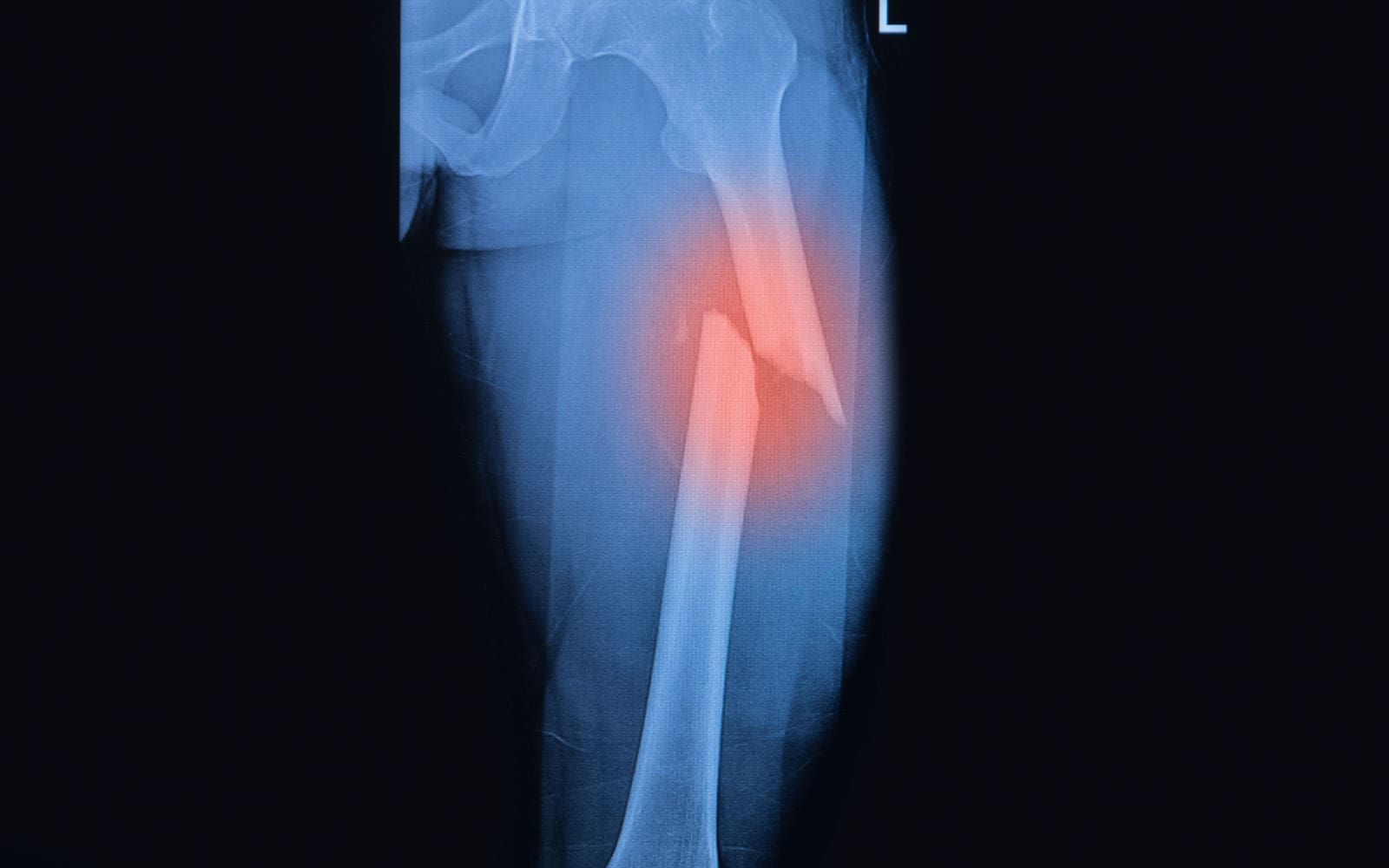 Femoral Fractures: Treating One Of Childhoods Most Common Bone Injuries -  Space Coast Orthopedicmerritt Orthopedics - Merritt Sports Medicine