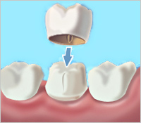 Animated Ceramic Crowns