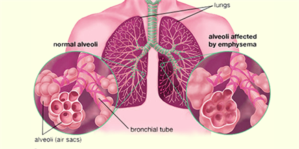 What is Emphysema ? - Causes and Symptoms of Emphysema