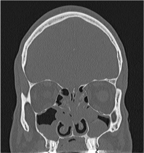 Nasal polyp CT-scan