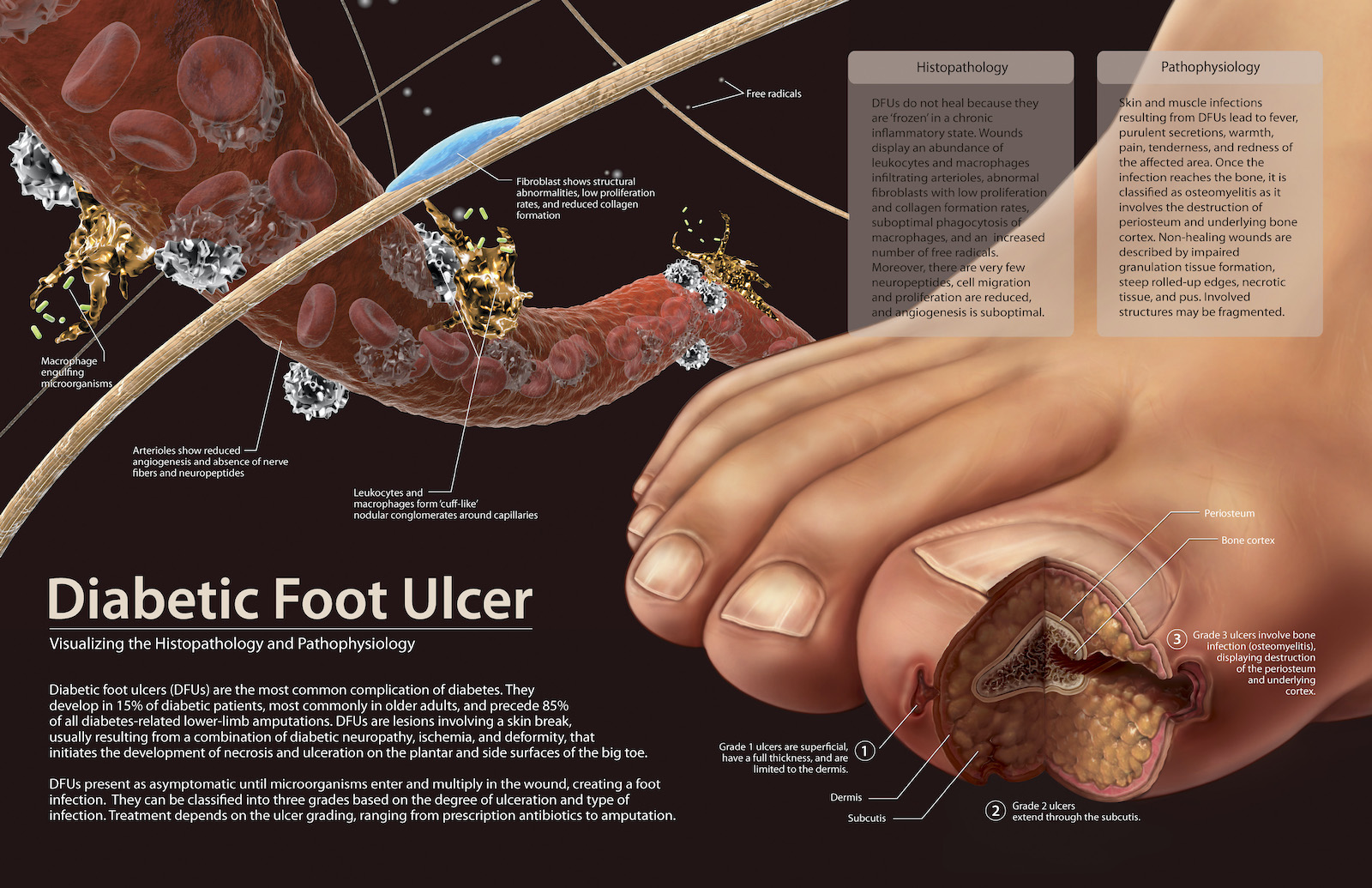 A detailed medical illustration showing a diabetic foot ulcer, highlighting the breakdown of skin and tissue on a big toe, with callouts explaining the stages of ulcer development and related complications such as infection.