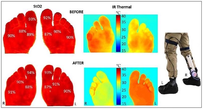 A graphic displaying before and after thermal images of feet affected by diabetic neuropathy, along with images of prosthetic legs, illustrating temperature changes and the impact of treatment.