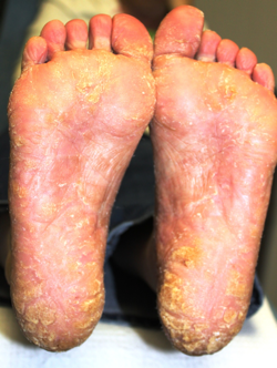 Psoriasis Ankle