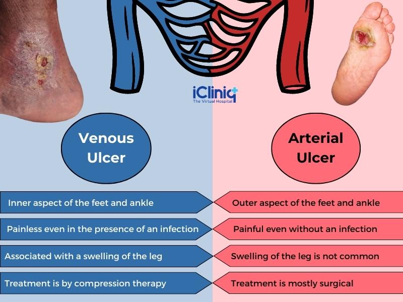 Arterial Vs Venous Ulcers What Are The Differences | Sexiz Pix