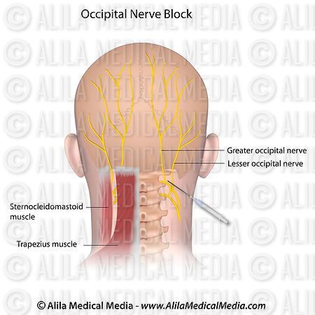 Occipital Nerve Block Anatomy