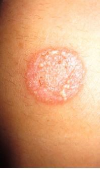 General practice series - Common skin lesions in children