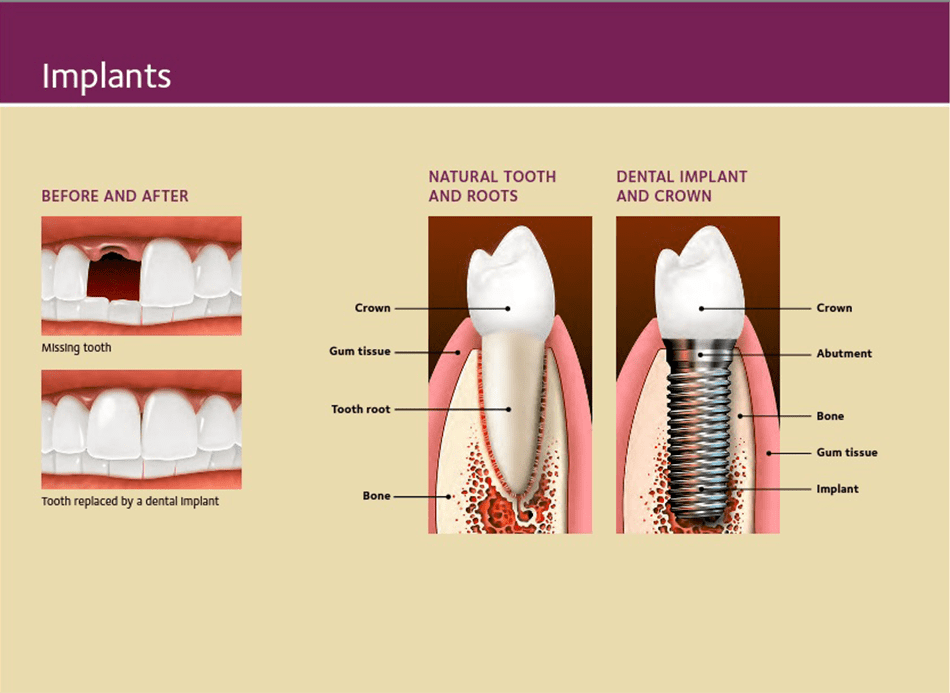 Dental Implants Specialist - Washington, DC: K Street Dental ...