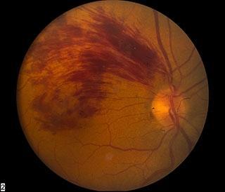 BRVO - Fairfield, CT & Hamden, CT: Connecticut Retina Consultants