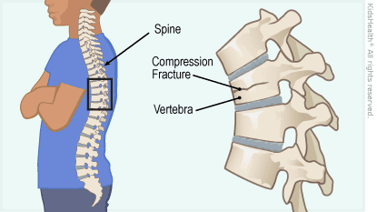 Compression Fracture Lumbar