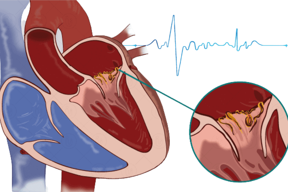 Endocarditis Symptoms Causes Mayo Clinic