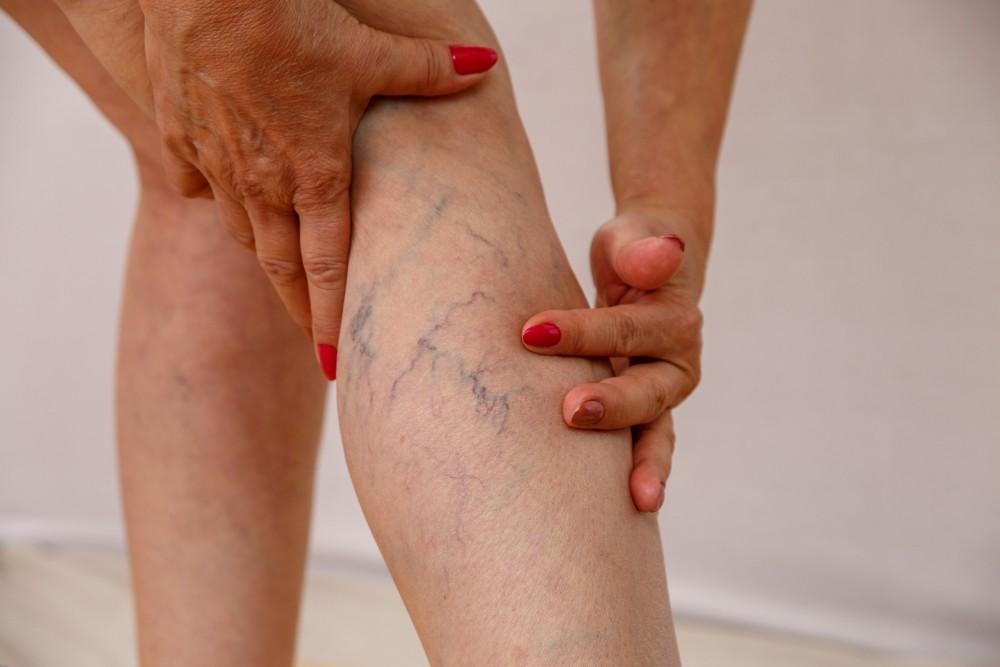 Are Varicose Veins A Health Concern?