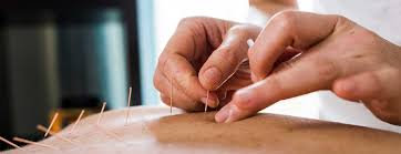 Different types of acupuncture