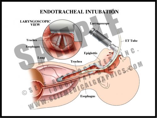 Medical Illustration of Endotracheal Intubation