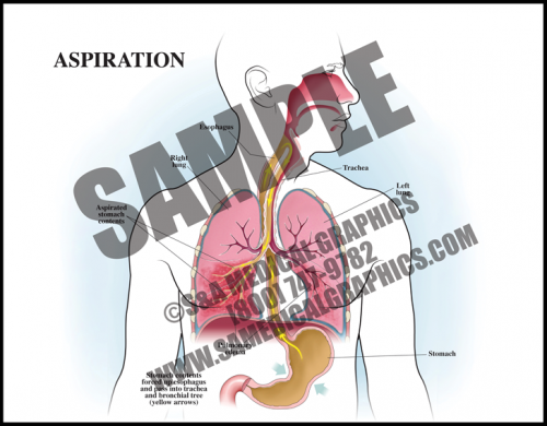 Medical Illustration of Aspiration