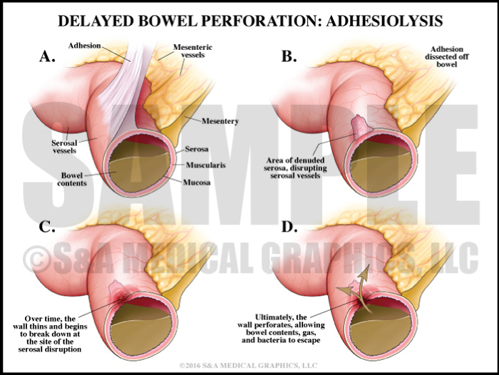 Delayed Bowel Perforation Adhesions Medical Illustration