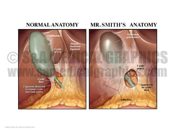 Gallbladder Bile Duct Medical Illustration