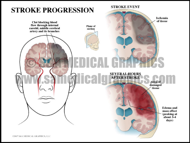 Stroke Progression