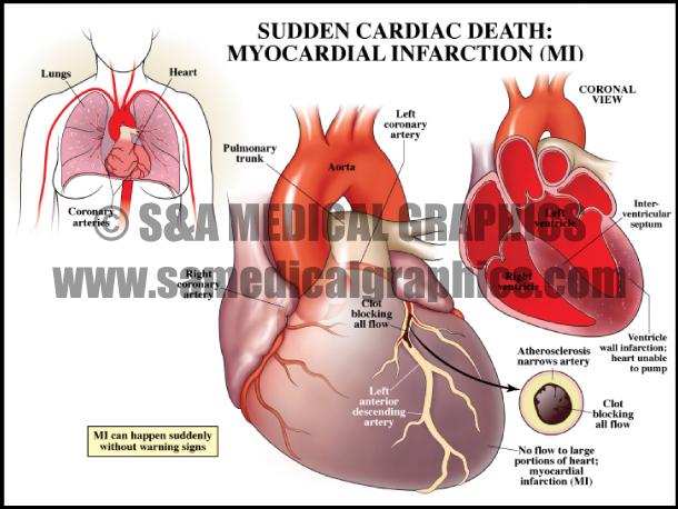 Myocardial Infarction Sample