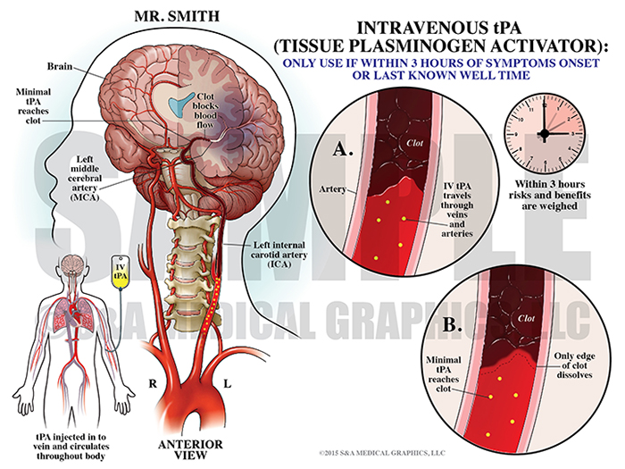 Intravenous tPA Tissue Plasminogen Activator