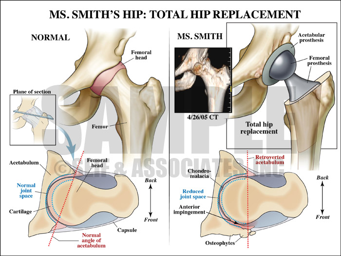 Total Hip Replacement Surgery Procedure