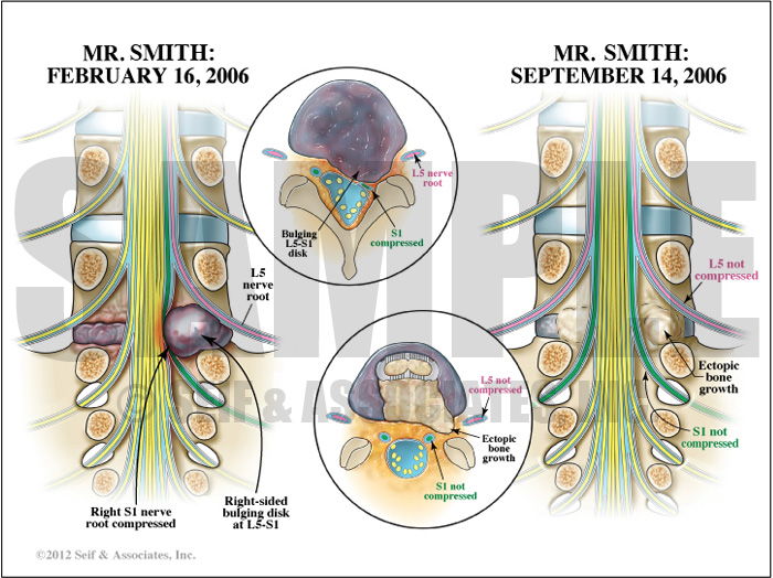 Lumbosacral Nerve Root Bulging Disk