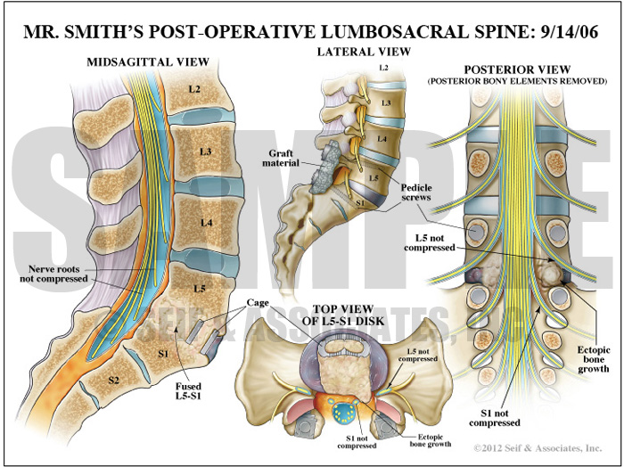 Lumbar Nerve Root Patterns