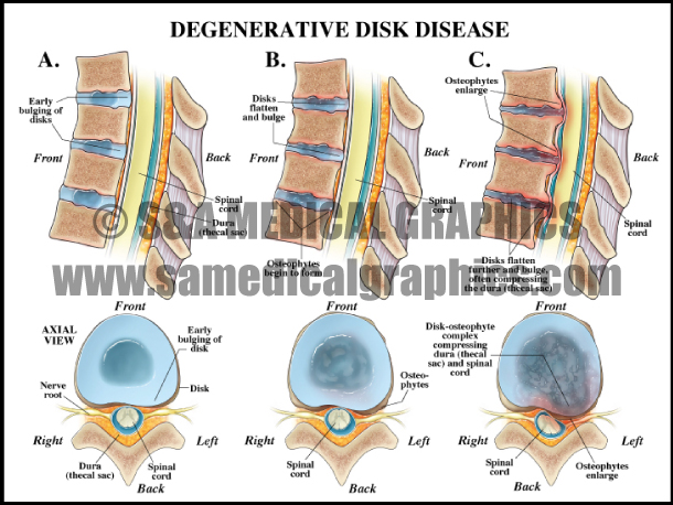 Degenerative Disk Disease Medical Illustration