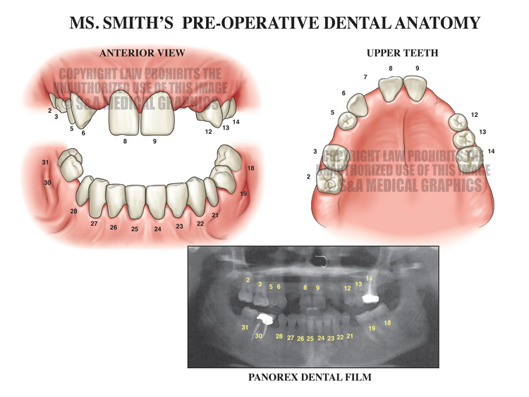 Dental Implant Surgery