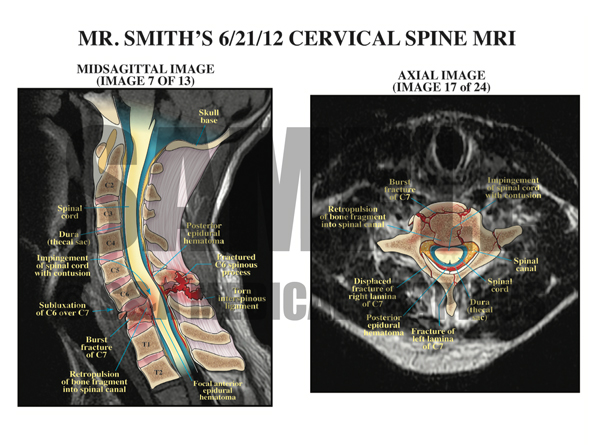 Cervical Spine MRI