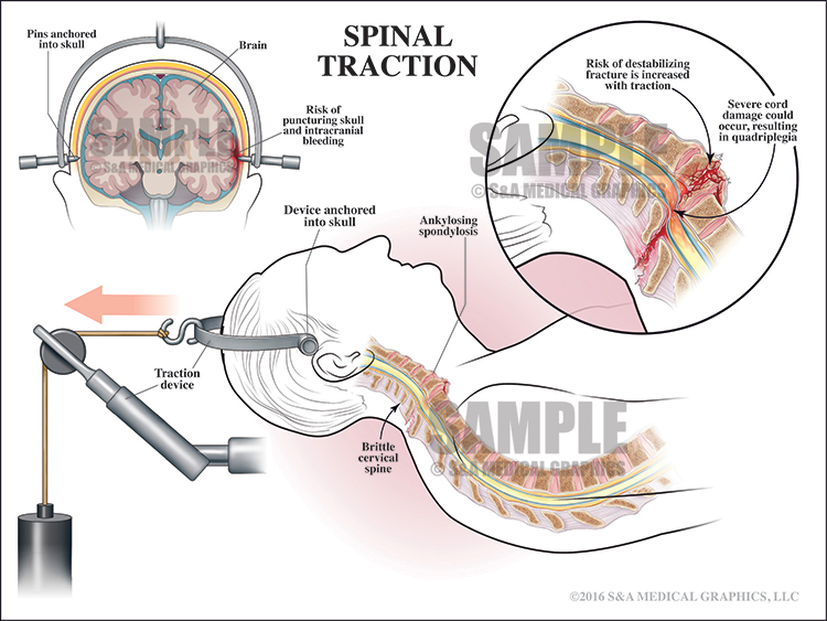 Spinal Traction