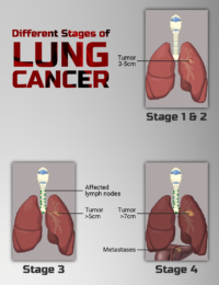 Why Is Lung Cancer So Difficult to Treat? Surgeon Answers » Scary Symptoms