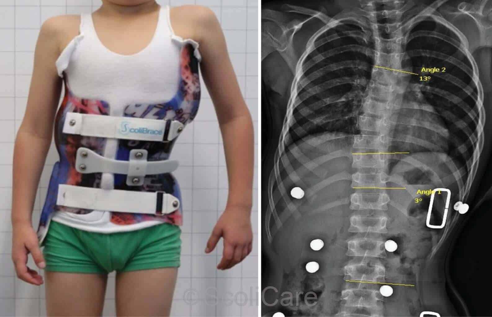 Patient wearing the new customised ScoliBrace orthosis (left), In-brace posteroanterior x-rays (right)