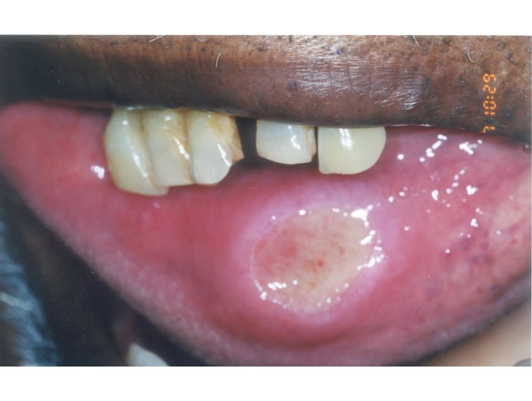 Squamous Cell Carcinoma Lip