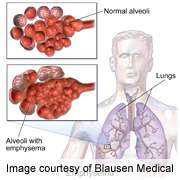 Greater emphysema-like lung on CT linked to mortality