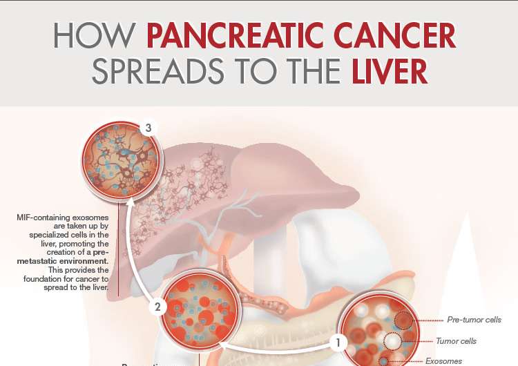 Study discovers how pancreatic cancer spreads to the liver