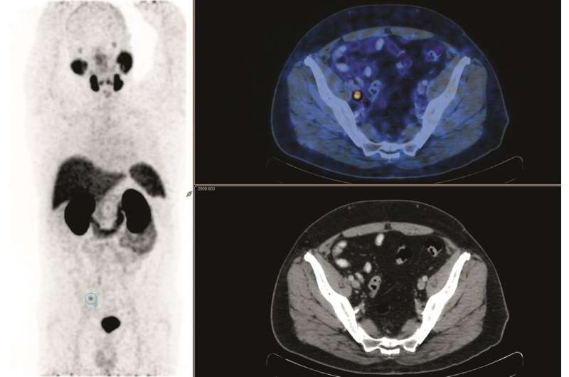 PET identifies which prostate cancer patients can benefit from salvage radiation treatment