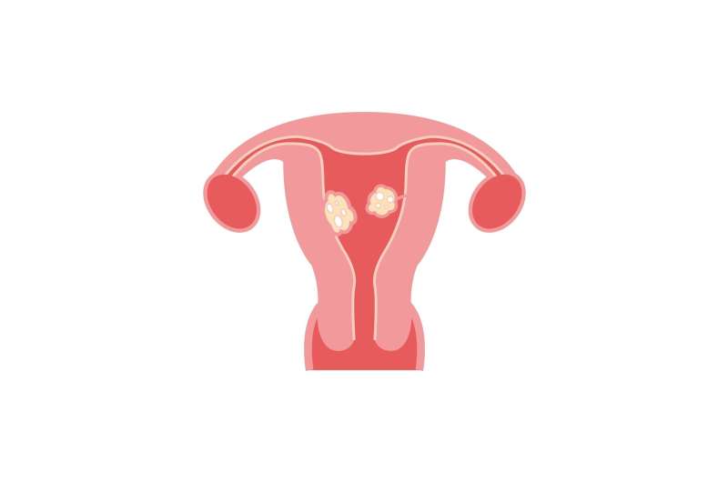 Survey finds most women with uterine fibroids are offered ...