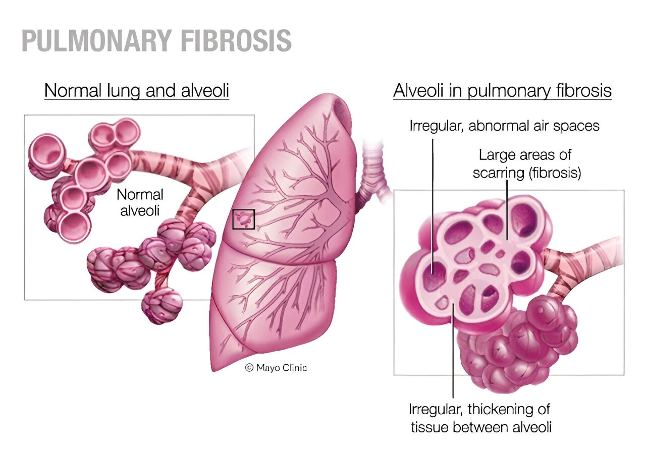 Hypersensitivity pneumonitis: Is your feather bedding making you sick?