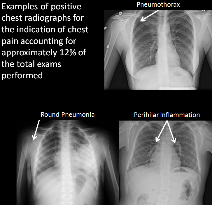 Normal Child Chest X Ray