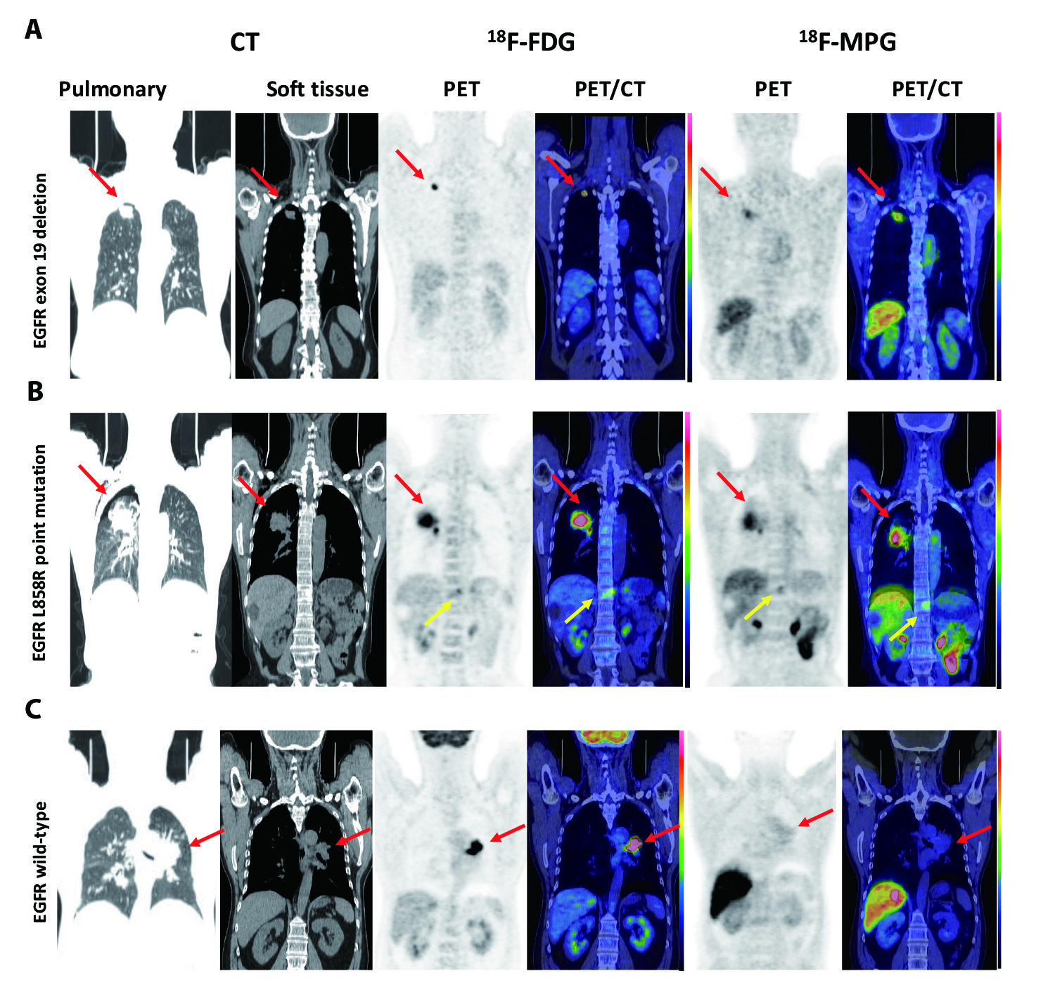 Pet Scan Images Lung Cancer