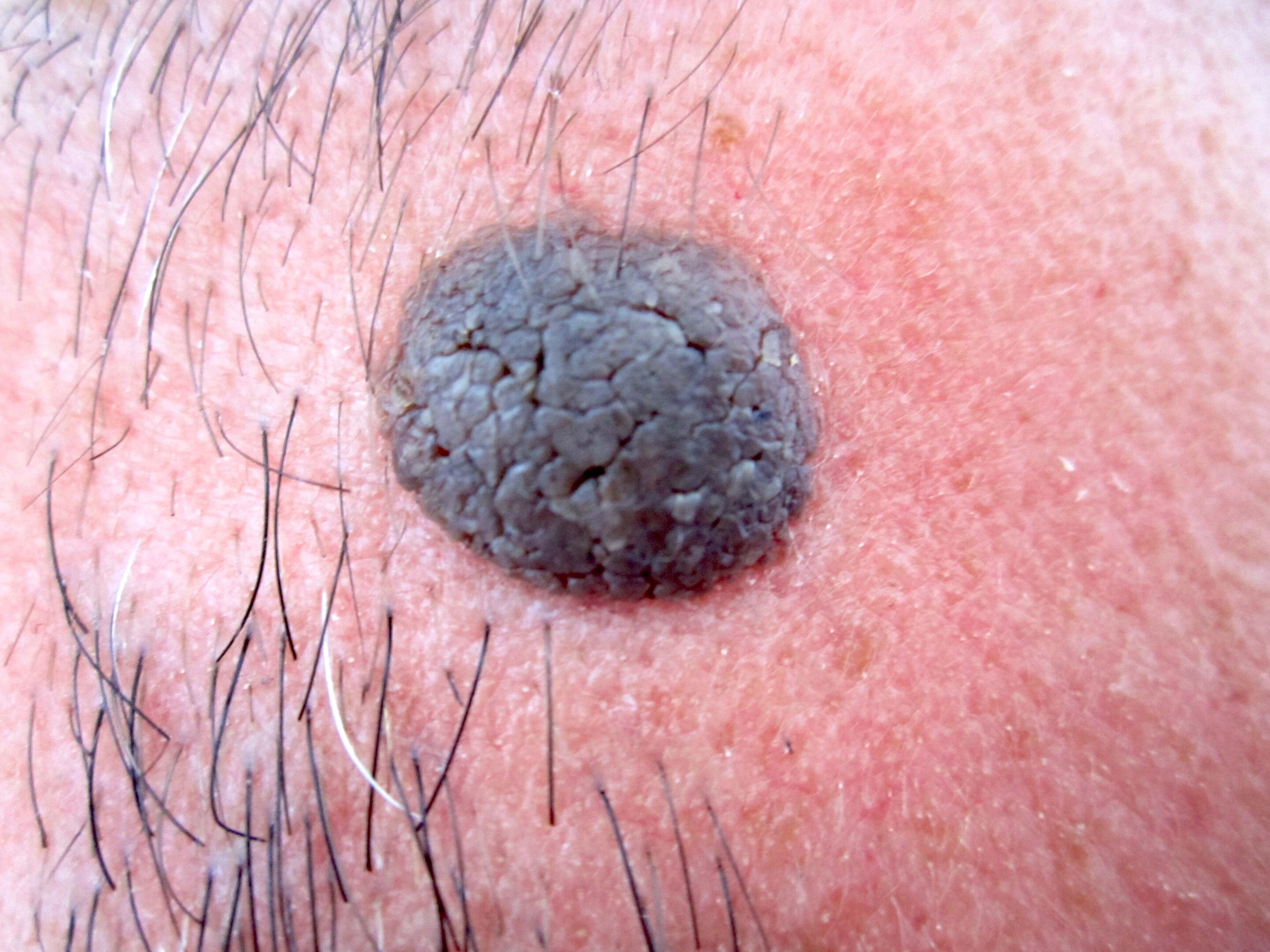 Melanoma Skin Moles