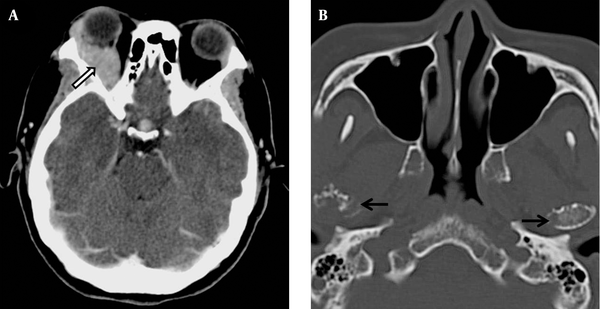 Non Secretory Multiple Myeloma With Extensive Extramedullary ...